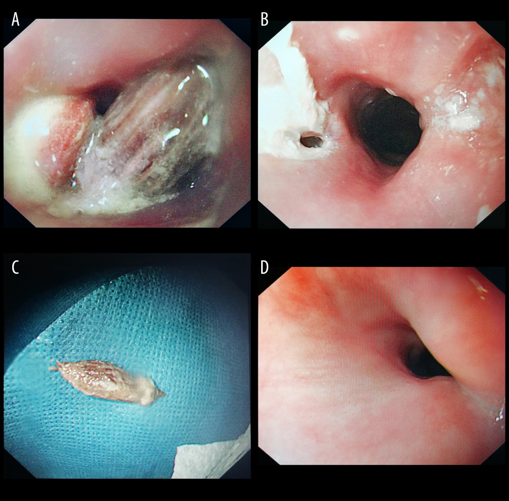 Jujube pit ingestion with perforation before and after endoscopic removal. (A) Jujube pit in the esophagus; (B) Perforation after removal; (C) Removed jujube pit; (D) Healed perforation during follow-up. Endoscopic images were recorded during procedures and edited via Microsoft PowerPoint (version 2016, Microsoft, USA).