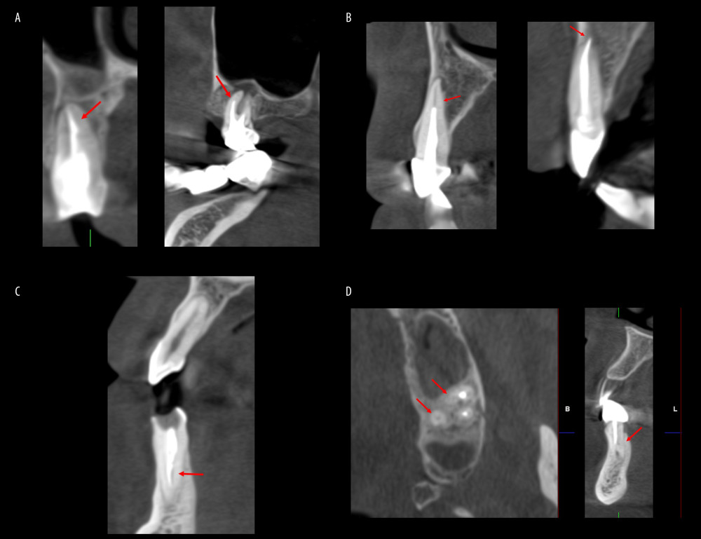 Procedural errors: (A) presence of broken instrument and ledge formation; (B) short root canal filling (RCF) and overextended RCF; (C) nonhomogeneous RCF; and (D) presence of missed canal in maxillary molar tooth andmandibular anterior tooth. Scans were reconstructed using Planmeca Romexis Viewer Software version 4.3.0.R (Planmeca, Helsinki, Finland).
