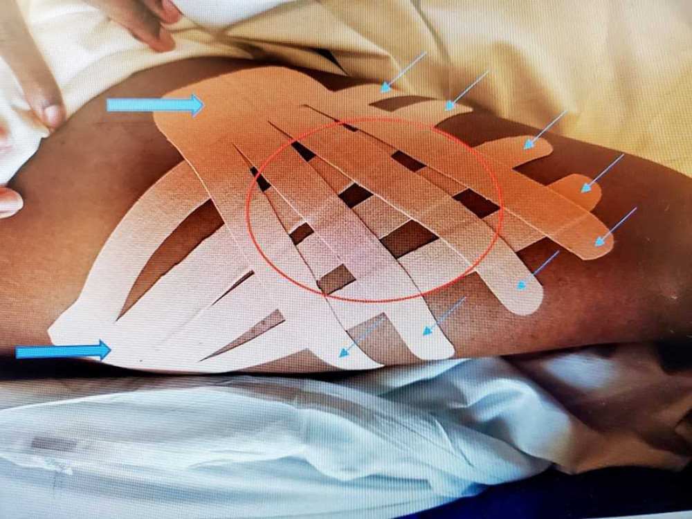 Kinesiology tape fan method applied to thigh areaKinesiology tape fan method application to right thigh. Thick blue arrows indicate tab of tape placed proximal to area of swelling. Thin blue arrows highlight projecting fingers of tape going distally to site of swelling. Red circle signifies area of swelling in which woven pattern of tape lays across.