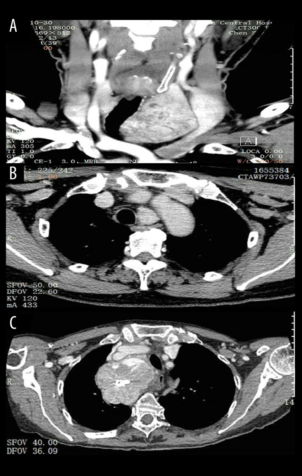 Three types of Retrosternal goiter are detected on computed tomographic (CT) scans. (A) Type I, after over half of the cervical goiter enters the sternum, the lower pole reaches the superior margin of the aortic arch; (B) Type II, the goiter is almost entirely posterior to the sternum, with the lower pole behind the aortic arch or entering the postmediastinum; (C) Type III, a huge intrathoracic goiter protrudes into the thorax, which may be accompanied by superior vena cava compression syndrome.