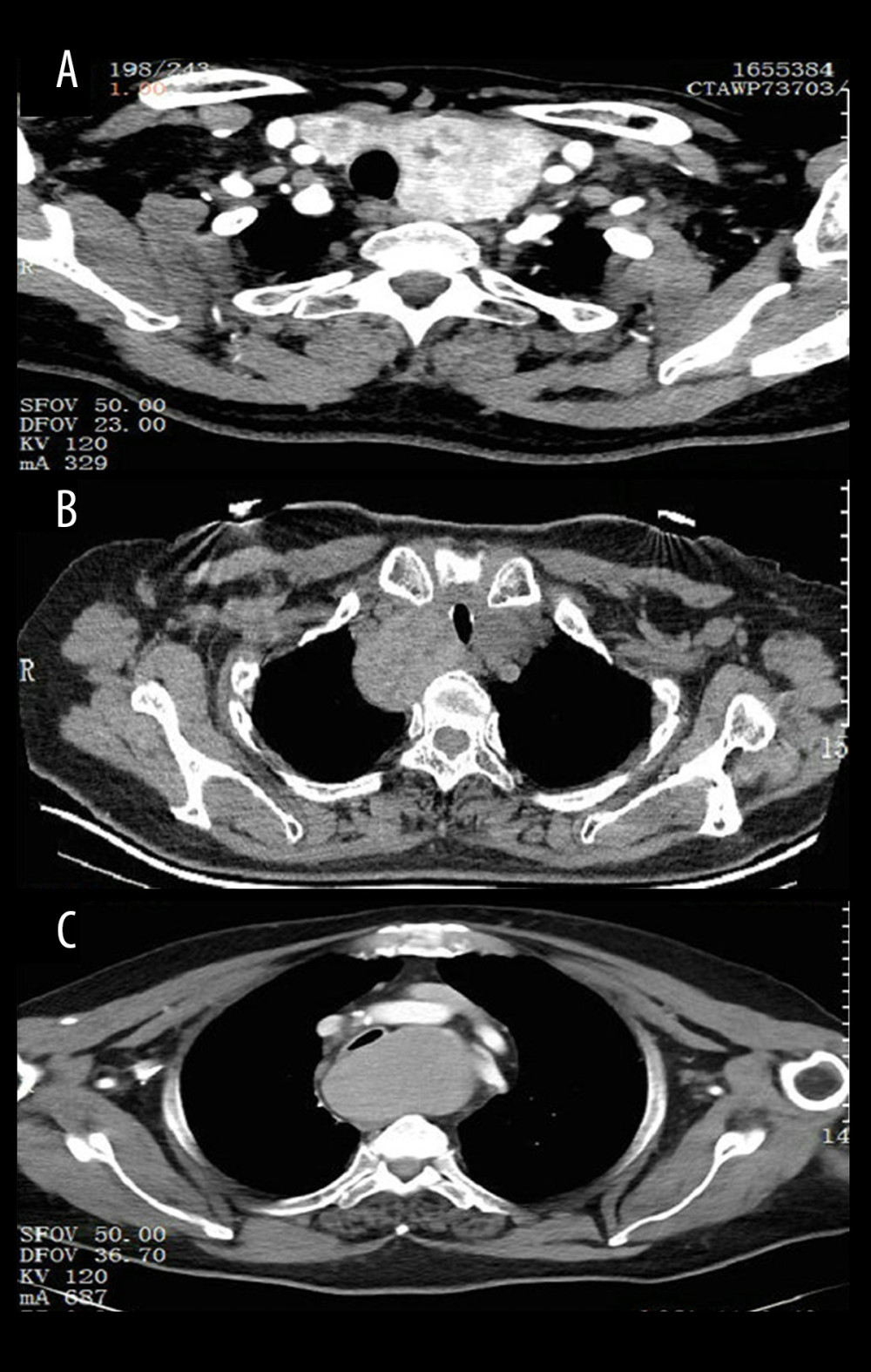Three grades of retrosternal goiter were detected on CT scans. (A) grade I stenosis, less than 50% obstruction; (B) grade II stenosis, 51% to 70% obstruction; (C) grade III stenosis, 71% to 99% obstruction. There were no cases of grade IV stenosis.