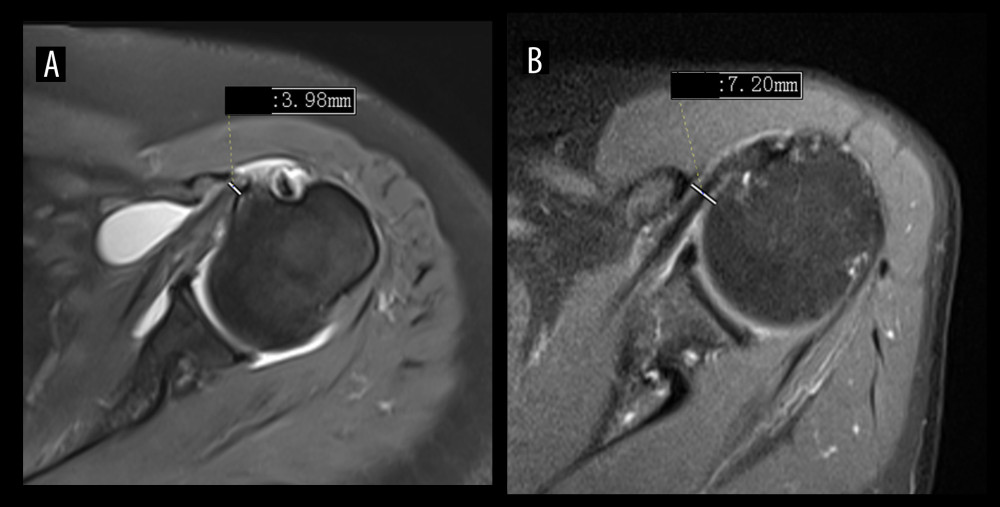 The CHD (3.98 mm) of subcoracoid impingement syndrome (A) was narrower than that of the normal shoulder (7.20 mm) (B). (Avanto 1.5T, Siemens; Neusoft PACS software, version 5.5.0.19075, Neusoft). CHD – coracoid-humeral distance.