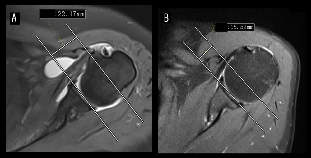 The CI (22.17 mm) of subcoracoid impingement syndrome (A) was longer than that of the normal shoulder (15.52 mm) (B). (Avanto 1.5T, Siemens; Neusoft PACS software, version 5.5.0.19075, Neusoft). CI – coracoid index.