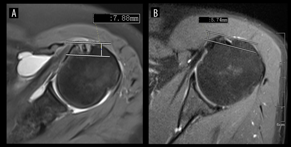 The HLT (7.88 mm) of subcoracoid impingement syndrome (A) was higher than that of normal shoulder (5.74 mm) (B). (Avanto 1.5T, Siemens; Neusoft PACS software, version 5.5.0.19075, Neusoft). HLT – height of lesser tuberosity.