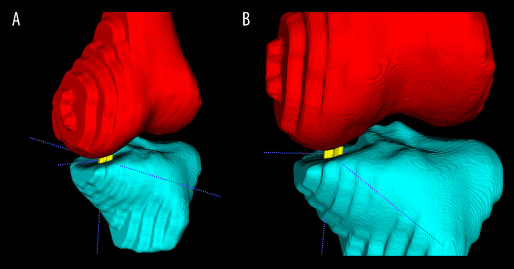 The illustration of knee joint space width and the location of minimal joint space width (mJSW) after automatic segmentation and 3D reconstruction. (A) Diagram of mJSW; (B) detail view. For this example, the location of mJSW is the lateral-anterior compartment, which may indicate there was an apparent lateral-anterior symptom for this patient. (Made by Itk-Snap 3.6.0).
