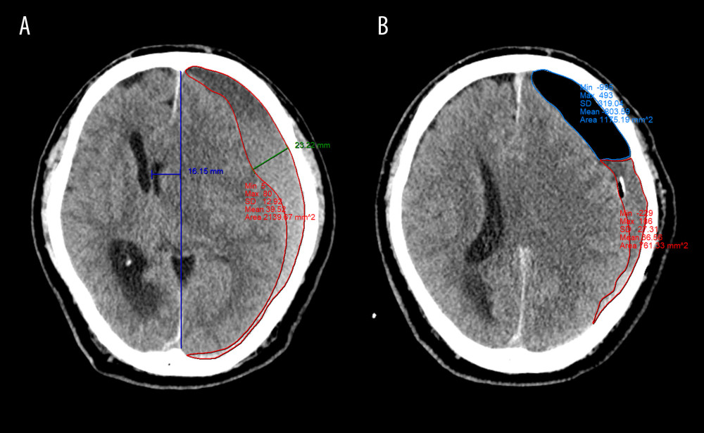Quantitative measurement of radiological parameters on axial computed tomography (CT) scans(A) The midline shift on CT scans was measured as the distance from the septum pellucidum to the virtual perpendicular drawn midline (deep blue line). The maximal thickness of the hematoma was measured as the largest diameter between the brain’s surface and the inner table of the skull (green line). The boundary of the hematoma was manually traced and then calculated in each image slice and multiplied by 5 mm to assess the volume of preoperative hematoma (red line). (B) In the postoperative period, the above hematoma volume measurement method was used to estimate the volume of residual hematoma (red line) and trapped air (light blue line). (FastStone capture 9.0, FastStone Soft, USA).