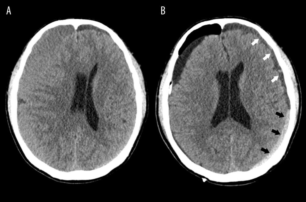 Representative image of contralateral subdural effusion (CSE) on axial computed tomography (CT) scans(A) Preoperative CT scan demonstrating isodense chronic subdural hematoma on the right-side causing a mass effect. (B) Postoperative day 4 follow-up CT scan showing remarkable resolution of the hematoma and a mass effect, but CSE (white arrows) containing separated acute hemorrhage (black arrows) was revealed. (FastStone capture 9.0, FastStone Soft, USA).