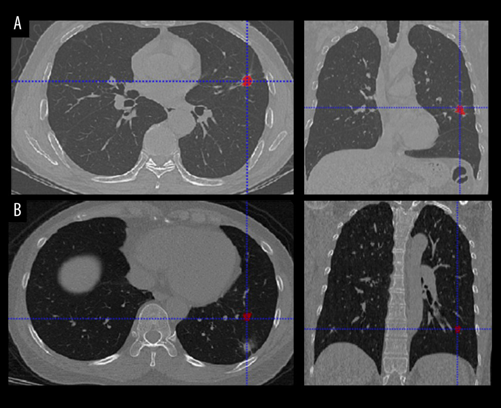 CT images with discordant interpretations between deep learning models and radiologists. (A) Model False-Positives: a 63-year-old male patient with histologically-confirmed benign nodule when the model predicts a malignant nodule. (B) Model False-Negatives: a 47-year-old male patient with histological-confirmed malignant nodule when the model predicts a benign nodule.