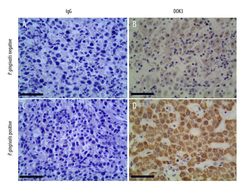 The expression of DOK3 in recurrent OSCC patients with differentP. gingivalis infections (B and D, 200×) compared with non-immune IgG staining as a control (A and C, 200×).The yellow-stained granules represent DOK3 staining-positive cells, and the larger yellow staining area represents higher DOK3 expression.