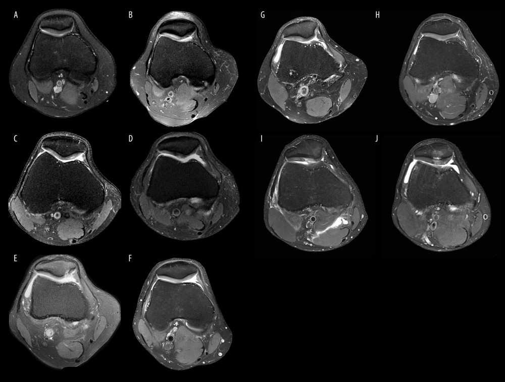 (A–J) Axial PD-weighted images with patellar chondromalacia (white arrows) with different Outterbridge classifications 0/1/2/3/4 (A/B/C/D/E).