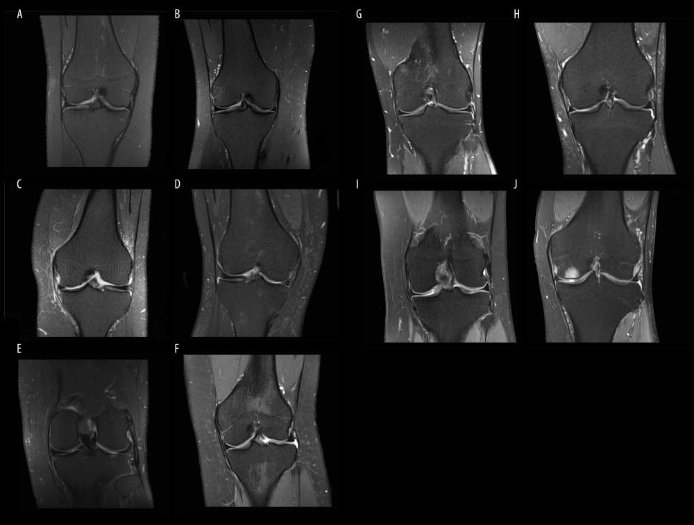 (A–J) Coronal PD-weighted images with femoral chondromalacia (white arrows) with different Outterbridge classifications 0/1/2/3/4 (A/B/C/D/E).