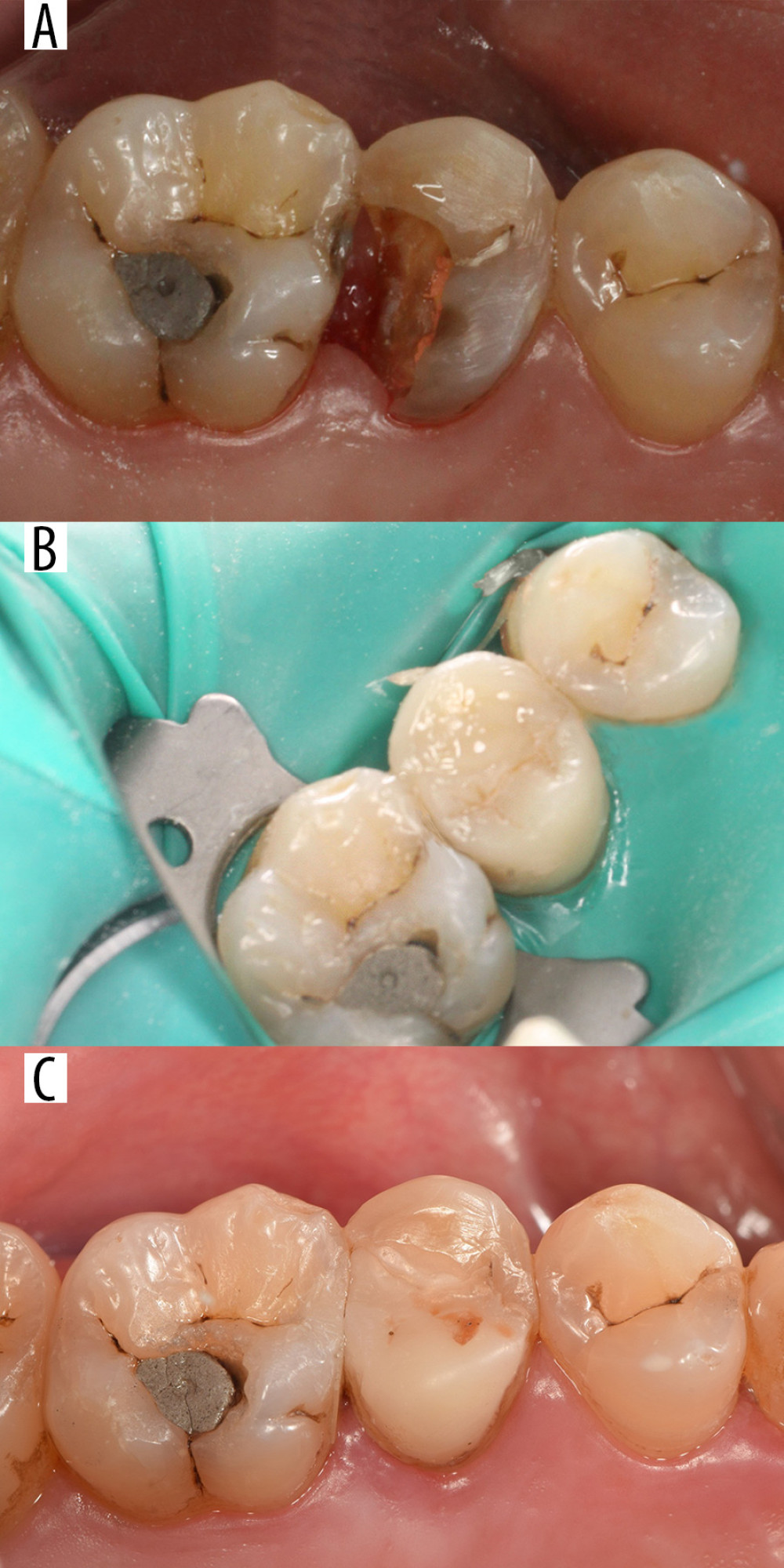 Tooth 25 restored with a resin nanoceramic (RNC) onlay. (A) Before cavity preparation. (B) Restoration after bonding (baseline). (C) Restoration after 36 months.