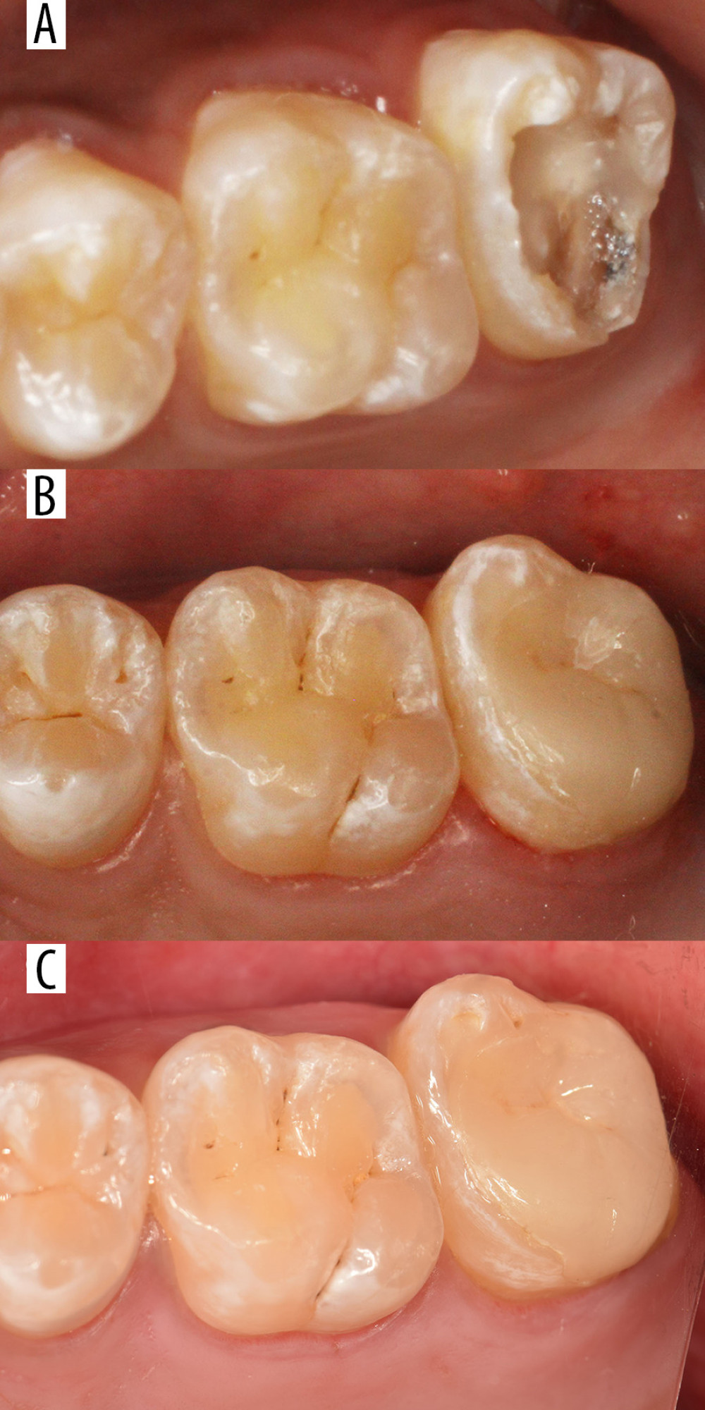 Tooth 27 restored with a lithium disilicate-based glass ceramic (LDGC) onlay. (A) Before cavity preparation. (B)4Restoration after bonding (baseline). (C) Restoration after 36 months.