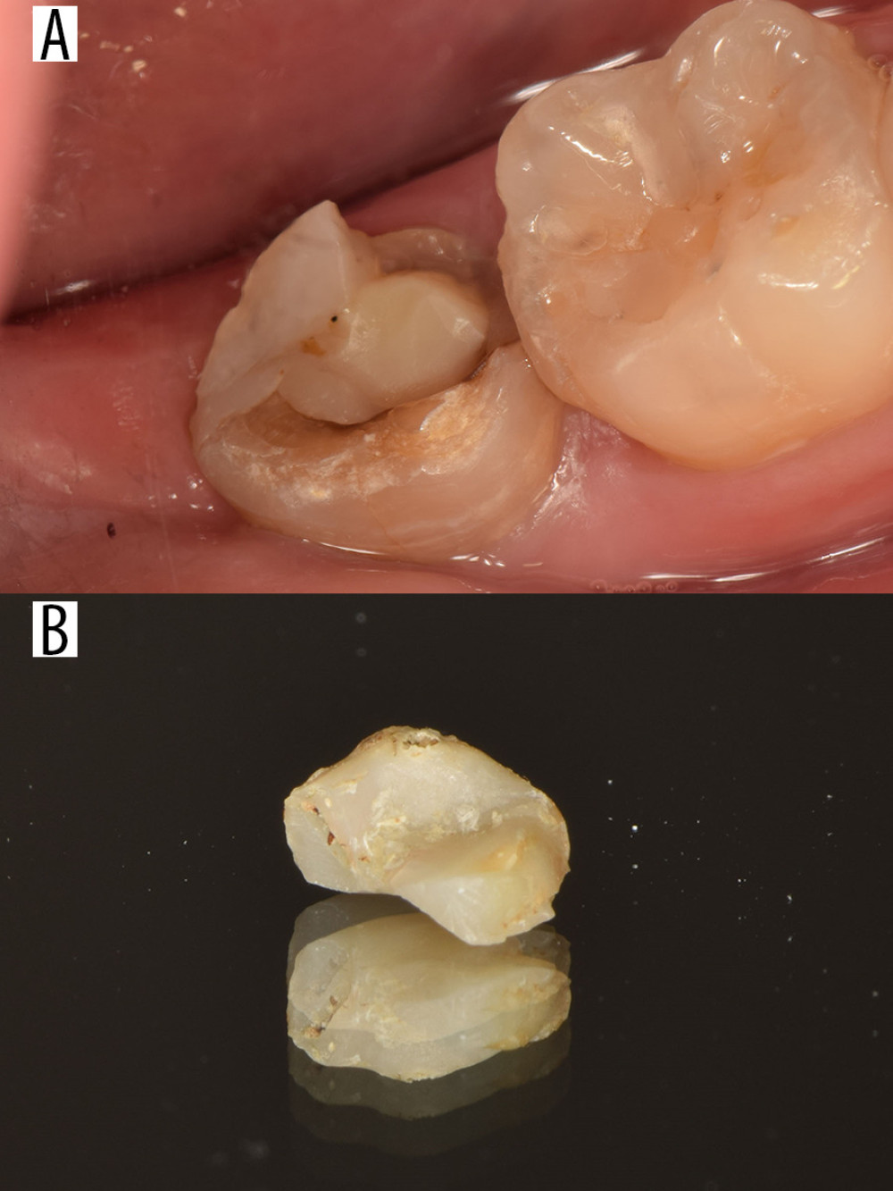 Failed case. Tooth 37 was restored with a resin nanoceramic (RNC) onlay, which fractured after 35 months. (A) Intraoral photograph of the onlay, which fractured after 35 months. (B) Photograph of the fractured onlay.