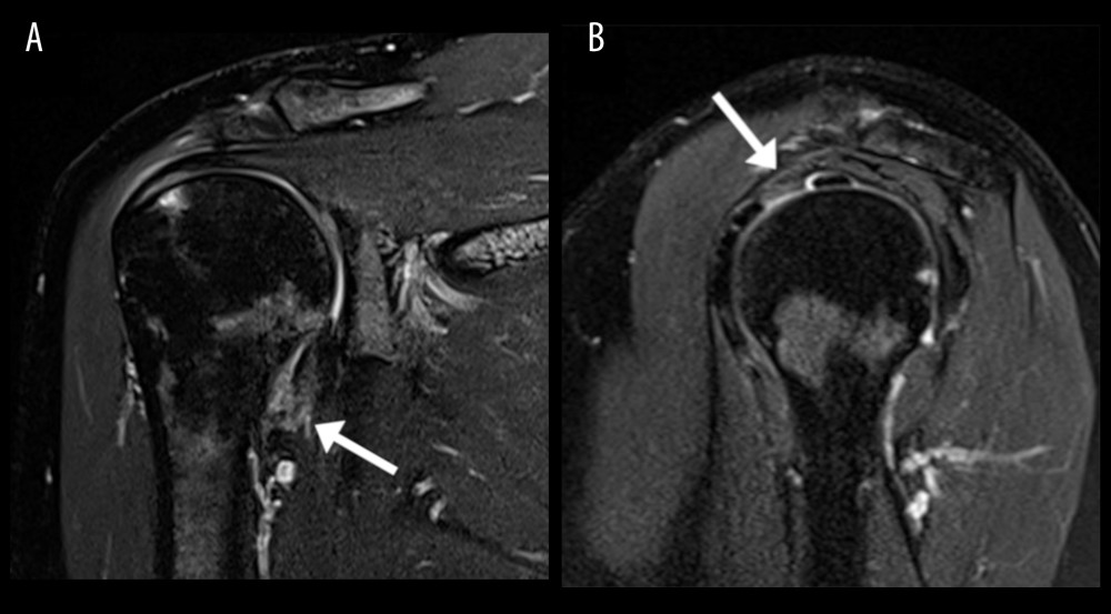 Imaging features of adhesive capsulitis. Magnetic resonance image (MRI) of the right shoulder; patient 13. On the coronal T2 fat-suppressed sequence (A) the arrow indicates thickening of the inferior joint capsule with hyperintense T2 signal. On the sagittal T2 fat-suppressed sequence (B) the arrow indicates thickening and mild hyperintense signal at the rotator interval.