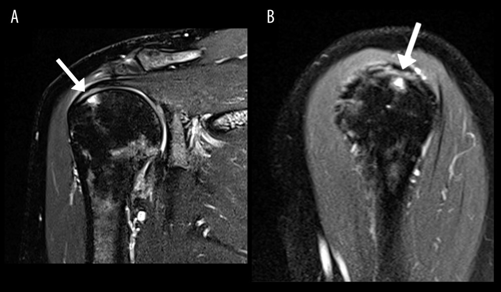 Imaging features of supraspinatus rotator cuff tear. Magnetic resonance image (MRI) of the right shoulder; patient 6. In the coronal T2 fat-suppressed image (A) the arrow points the articular side of a partial tear of the supraspinatus tendon, involving 50% of the tendon thickness. Also noted is underlying marrow edema at the greater tuberosity of the humerus. In the sagittal T2 fat-suppressed image (B), the arrow again points to the articular side of the partial thickness tear of the supraspinatus tendon, further confirming 50% of tendon thickness involvement.