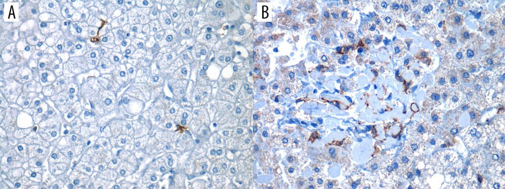 Positive expression of hepatic dendritic cells (CD11c+, hDCs) in liver tissue (40×)Photomicrograph showing CD11c+ immunostained cells in 2 different liver biopsies, visualized in 40× objective. (A) Focal expression: low number of hDCs (CD11c+) in less than 3 fields/40×. (B) Diffuse expression: high number of hDCs (CD11c+) are found in more than 3 fields/40×.