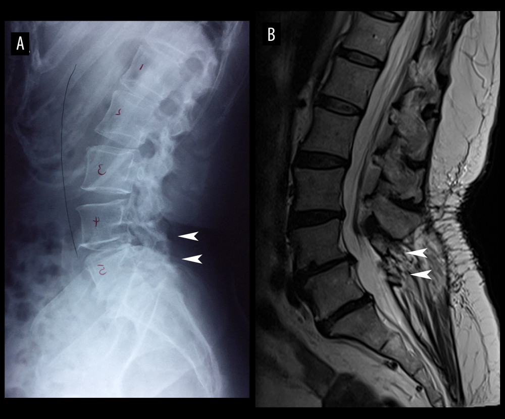 Lumbar spine imaging following laminectomy. Lateral lumbar radiograph, taken at an outside facility, with (A) markings drawn by a previous provider and (B) T2-weighted lumbar mid-sagittal magnetic resonance image ordered by the chiropractor shows removal of the laminae and spinous processes from the L4/5 to L5/S1 levels (arrows). This 49-year-old woman presented with a 1-year history of severe right-sided sciatic pain, right leg numbness and weakness, and severe low back-related disability following laminectomy. With 12 visits of spinal manipulation and mechanical traction over a 3-month span, she experienced a near-complete resolution of symptoms. Her symptoms recurred by the 1-year follow-up after concluding treatment.