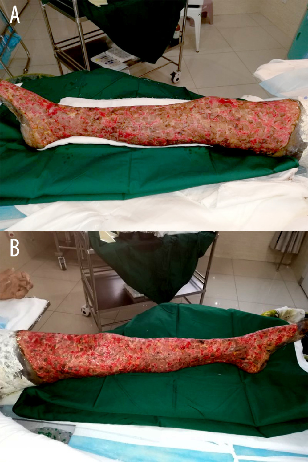 Skin graft 1 week after the operation. (A, B) The skin grafts took well 1 week after the operation, and the take rate of skin grafting was almost 100%.