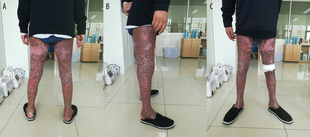 Follow-up at 6 months after discharge. (A–C) Six months after discharge, the autografts remained stable, and the patient could walk by himself without a walking stick.