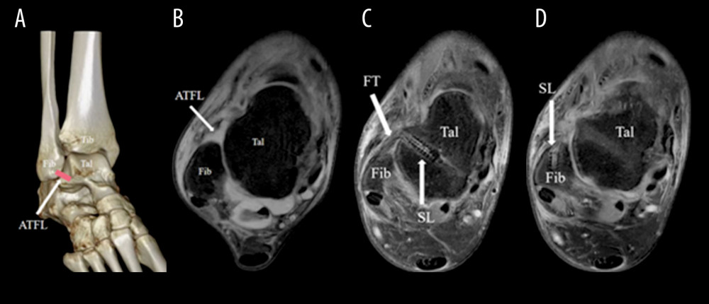 Preoperative and postoperative images of a 25-year-old male patient with right CLAI treated with InternalBrace™. (A) Preoperative computed tomography showed no fracture of ankle joint. (B) Preoperative MRI showed ATFL ligament III injury. (C, D) Postoperative MRI cross-sectional manifestation showed the location of InternalBrace™. Tib – tibia; Fib – fibulare; Tal – talus; ATFL – anterior talofibular ligament. TA – tibialis anterior; FT – FiberTape; SL – SwiveLock.