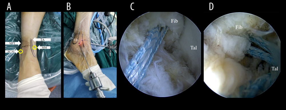 Intraoperative Images of a 25-year-old male patient with right CLAI treated with InternalBraceTM. (A, B) Location of arthroscopic approach. (C) Drill and place an SwiveLock with FiberTape at the fibular footprint ATFL. (D) Complete ATFL ligament reconstruction with InternalBraceTM and check the lateral stability of ankle joint with arthroscopy. TA – tibialis anterior; MPT – musculus peronaeus tertius; MM – medial midline approach; ACAL – accessory anterolateral approach.