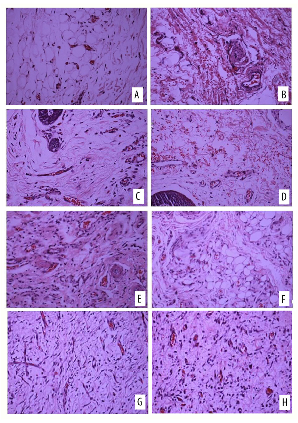 Hematoxylin and eosin (H&E) staining of (A) the experimental side and (B) the control side 7 days after surgery (group A). H&E staining of (C) the experimental side and (D) the control side 14 days after surgery (group B). H&E staining of (E) the experimental side and (F) the control side 7 days after surgery (group C). H&E staining of (G) the experimental side and (H) the control side 14 days after surgery (group D). All magnification is ×200.