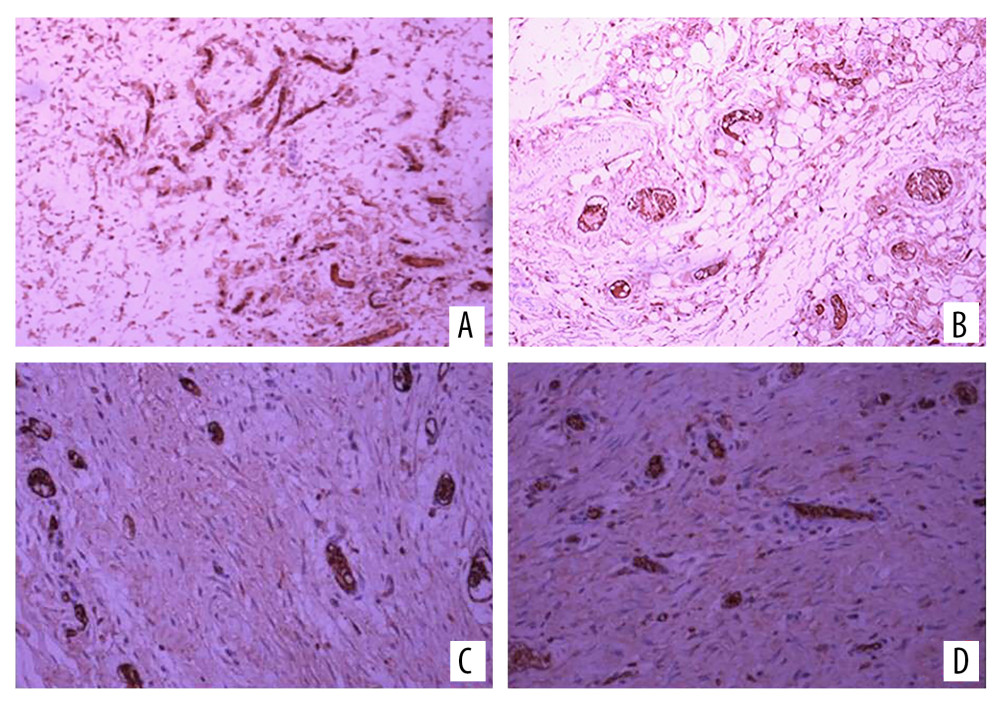 Vascular endothelial growth factor (VEGF) immunohistochemical staining on (A) the experimental side and (B) the control side 7 days after the second stage surgery (group C); VEGF immunohistochemical staining 14 days after the second stage surgery (group D) on (C) the experimental side and (D) the control side. All magnification is ×200.