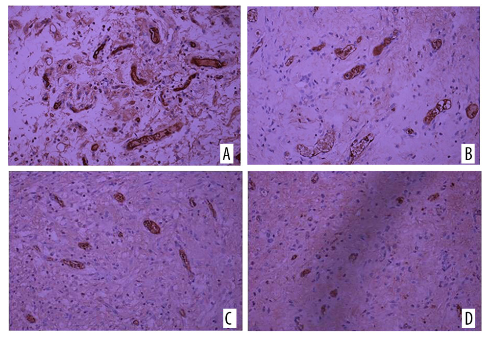 Immunohistochemical staining of CD34 on (A) the experimental side and (B) the control side 7 days after the second surgery stage (group C). CD34 immunohistochemical staining on (C) the experimental side and (D) the control side 14 days after the second surgery stage (group D). All magnification is ×200.