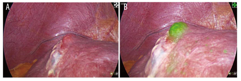 (A) Tumor residues after ultrasound-guided percutaneous microwave ablation. (B) Fluorescence imaging of tumor residues after ultrasound-guided percutaneous microwave ablation.