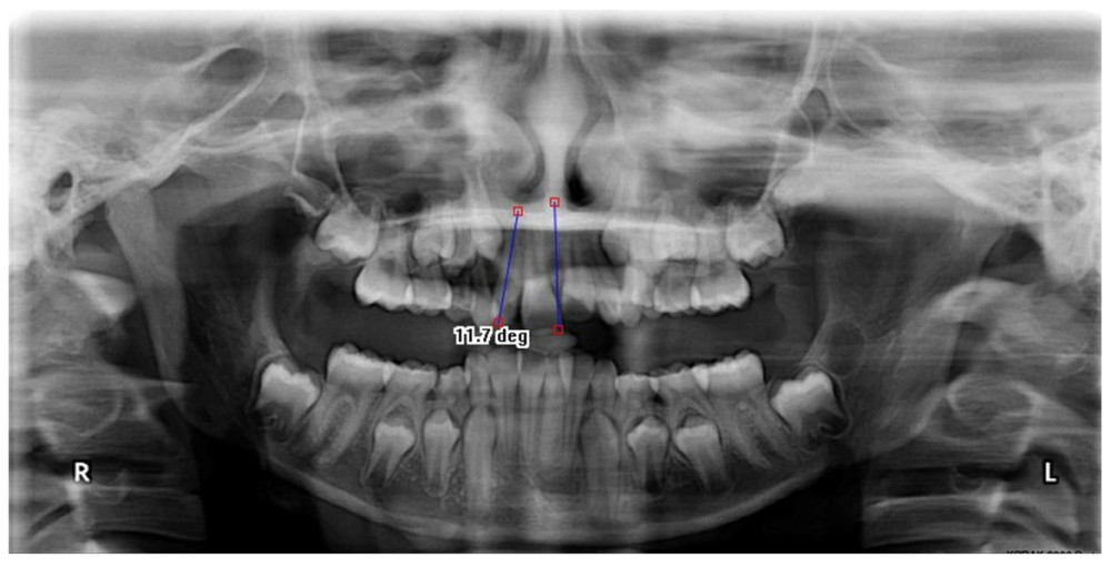 Angle formed by long axis of lateral incisor (LI) and midline between the central incisors on orthopantomograph.