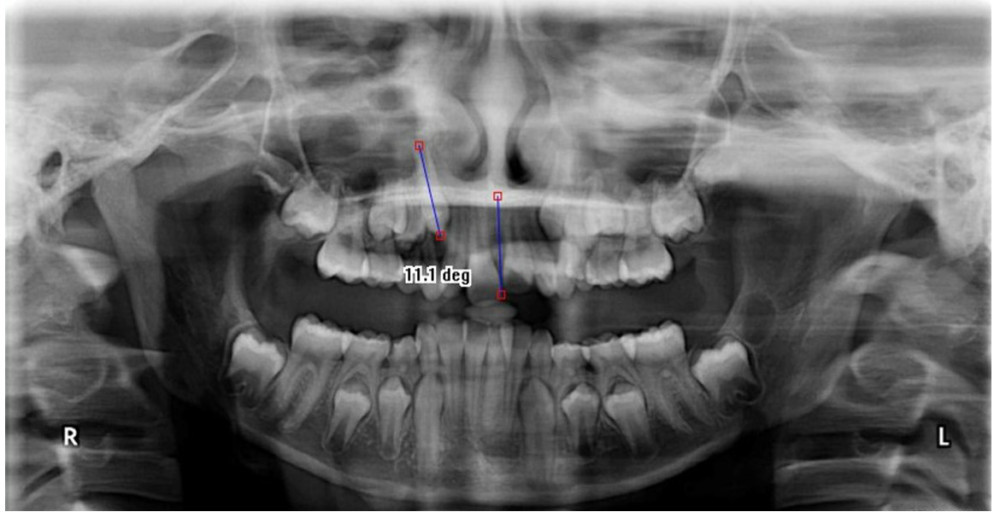 Medical Science Monitor Evaluation of Mesiodistal Root Angulation of