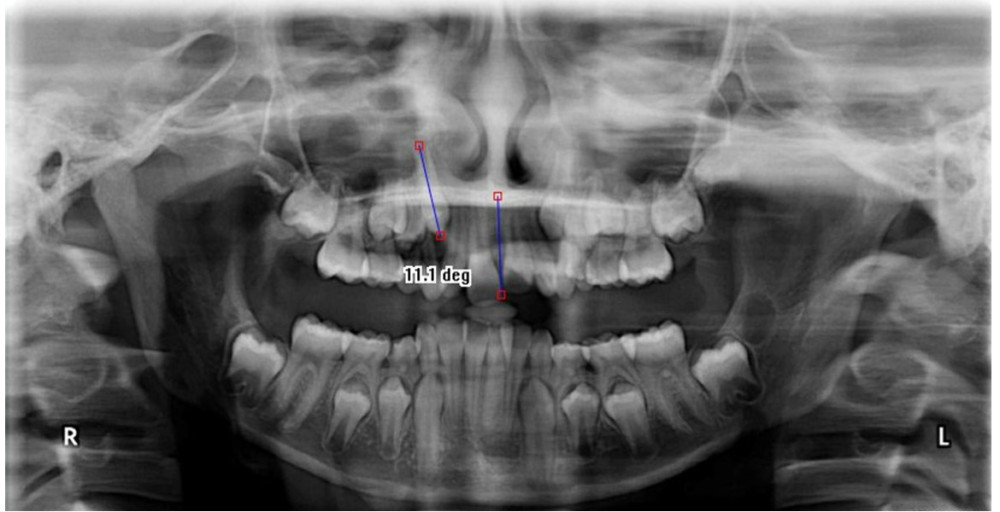 Angle formed by the long axis of canine (C) and midline between the central incisor on orthopantomograph.