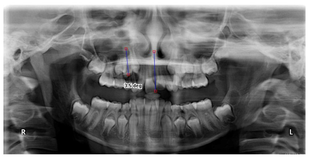 Angle formed by the long axis of first premolar (FP) and midline between the central incisor on orthopantomograph.