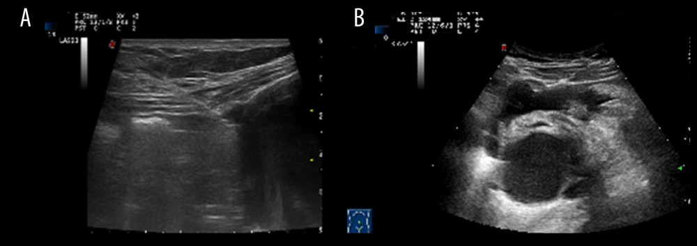 Target puncture and analysis of injection of artificial pelvic isolation fluid. (A) Target puncture with 18G-PTC needle under ultrasound guidance. (B) Convex array probe to observe the injection of artificial pelvic isolation fluid.