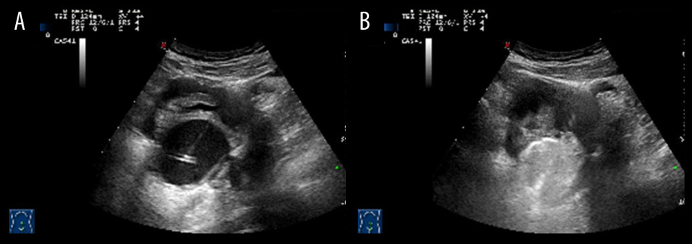 PTC puncture needle and cyst fluid operation monitoring. (A) Under the real-time guidance of ultrasound, the PTC puncture needle is punctured to the endometriosis and ovarian endometriosis cyst center. (B) Repeated replacement and flushing of 95% medical ethanol with one-third of the total cyst fluid.