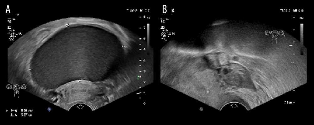 Analysis of endometriosis and ovarian endometriosis cyst before surgery and after surgery in a patient. (A) In a patient with an endometriosis and ovarian endometriosis cyst (OEC), the preoperative OEC diameter was 8.9 cm, and the left ovary was unclear. (B) Eight months after puncture sclerotherapy, the OEC disappeared and the left ovary was clearly displayed.