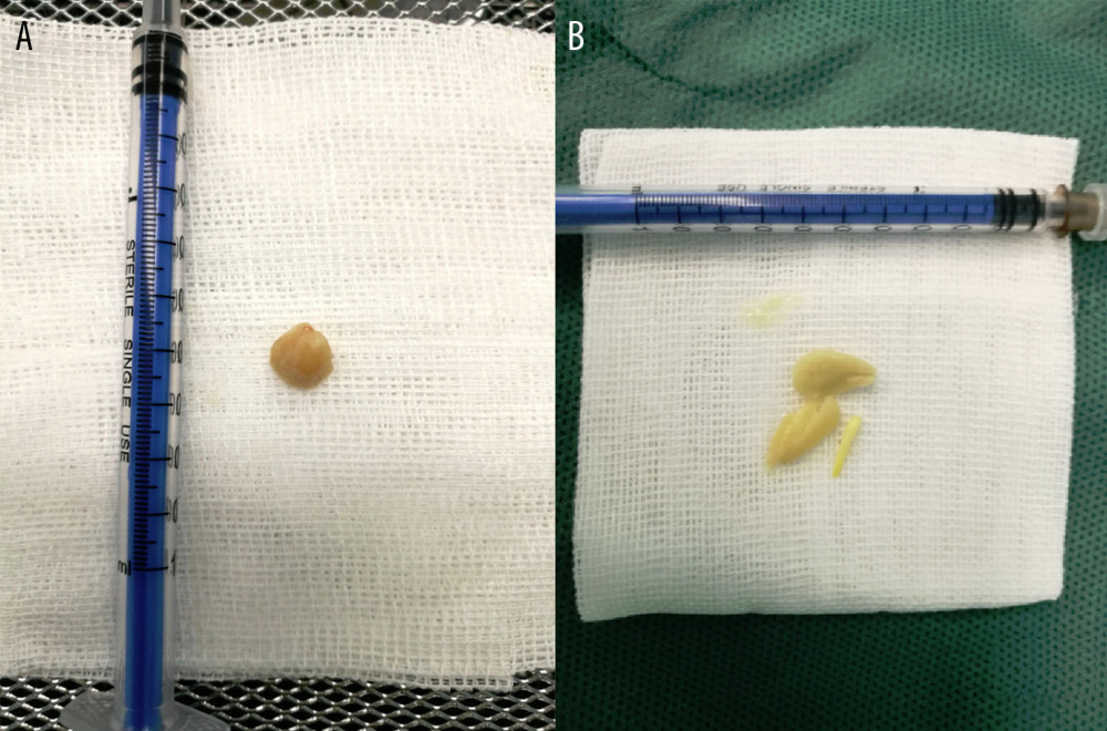 Both (A) and (B) are peanuts removed from the bronchus.