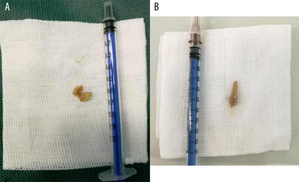 Both (A) and (B) are melon seeds removed from the bronchus.