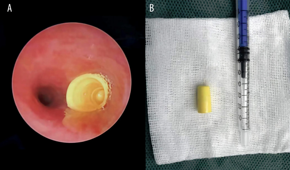 (A) Intraoperative photograph of a plastic toy located in right bronchus. (B) Postoperative photograph of the plastic toy.