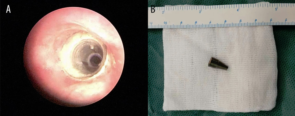 (A) Intraoperative photograph of a pen head located in right bronchus. (B) Postoperative photograph of the pen head.