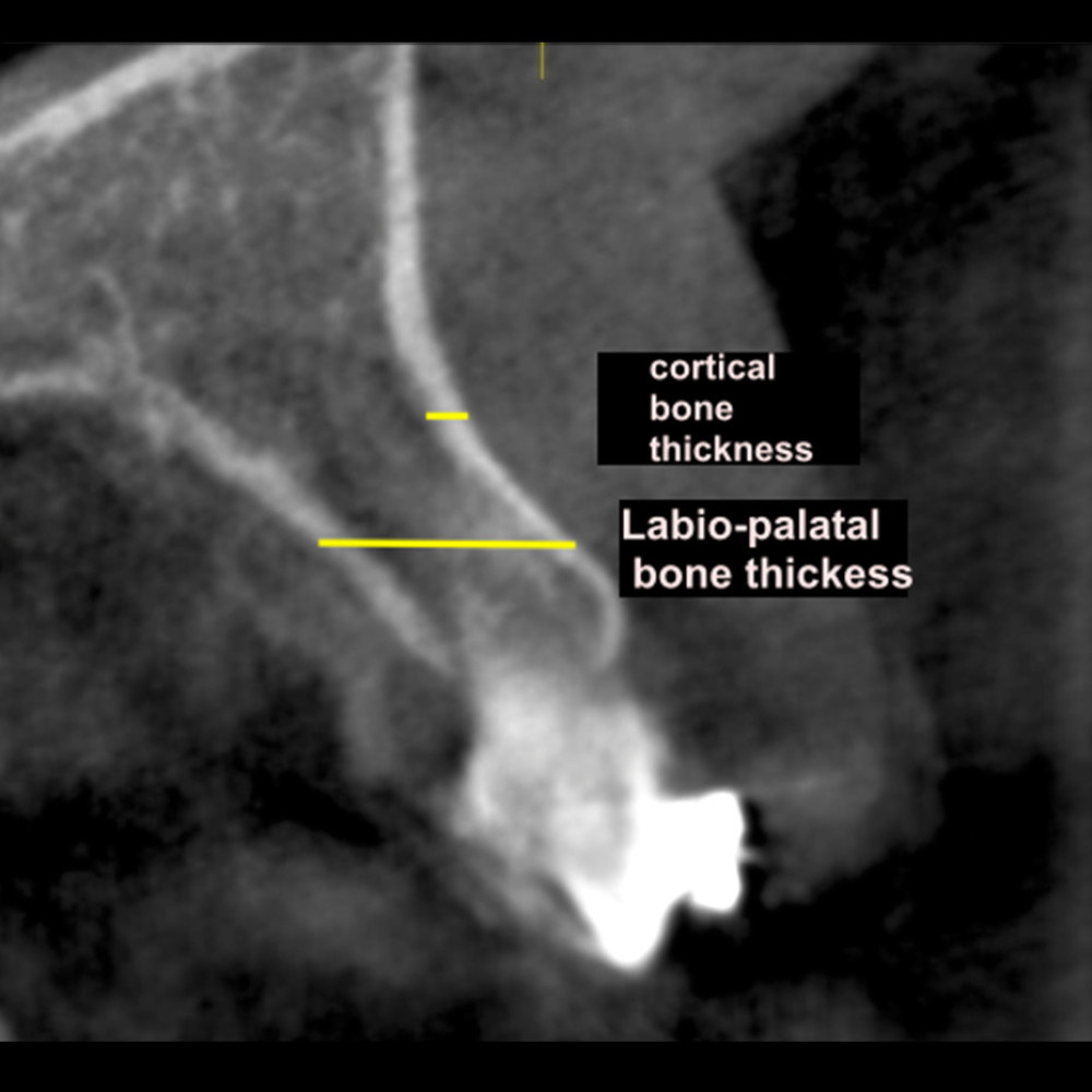 Method of measurement of labial cortical thickness and labio-palatal bone thickness in sagittal view.