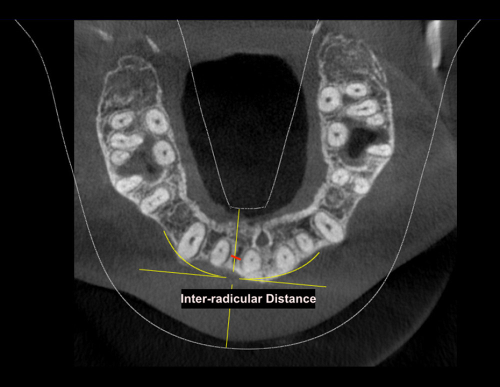 Method of measurement of inter-radicular distance in axial view.