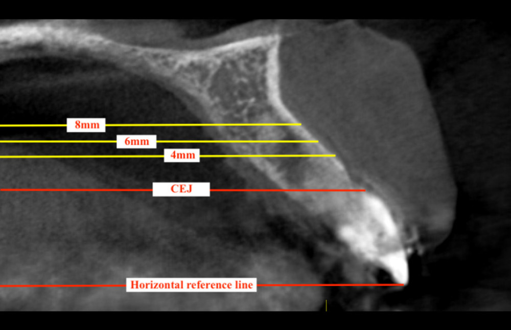 Markings of horizontal reference line and interdental cementoenamel junction. Bone thickness measured at reference lines of 4 mm, 6 mm, and 8 mm above the cementoenamel junction.