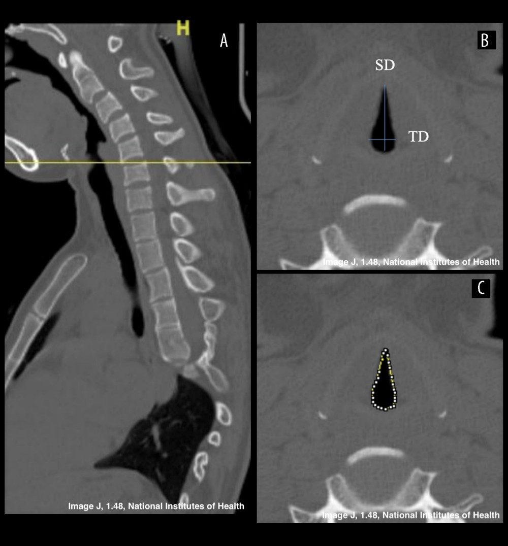 Measurement of glottic entrance parameters. (A) Cross-reference of sagittal image helps to find location of glottic entrance. Most of them are located at the level of epiglottic cartilage, but in some patients the narrowest plane is regarded as the glottic entrance. (B) Sagittal diameter is the distance from anterior end and posterior end of glottic entrance (line a). Transverse diameter is the broadest distance between lateral sides. (C) Cross-section area is measured by linking points on the medial wall of the glottic entrance.