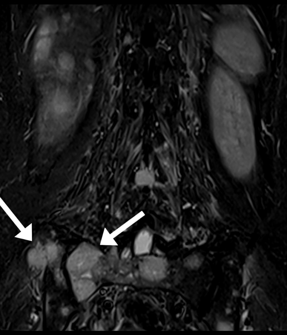 Spinal metastasis. This 53-year-old woman with a remote history of breast cancer presented to a chiropractor with a 3-month history of progressively worsening low back pain with radiation into the lower extremities bilaterally and lower extremity weakness. She previously presented to the emergency department and had been referred for physical therapy. Lumbar magnetic resonance imaging showed several findings consistent with bony metastasis, including lesions of the sacrum and ilium (arrows in T2-weighted coronal image), liver, and lumbar spine. The patient was referred to an oncologist for further management. Arrows added by RT using GNU Image Manipulation Program (Version 2.10.30).