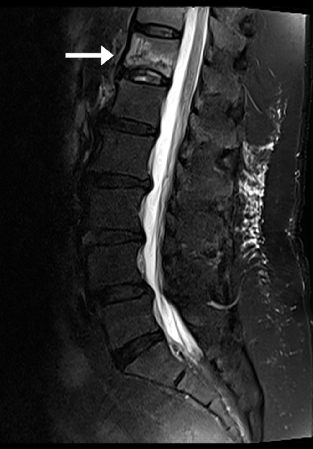 Osteoporotic compression fracture. This 72-year-old woman presented with a 1-month history of low back pain with radiation into the left paraspinal region and numbness in the left anterior thigh beginning after a fall from ground level onto her knee. She had been receiving acupuncture and traditional bonesetting therapy and had no previous imaging. The T12 vertebral body shows marrow edema and a hypointense horizontal fracture line is noted in this T2-weighted mid-sagittal image (arrow), which remains hypointense in T1-weighted images (not shown). The patient was referred to an orthopedist but was ultimately treated conservatively. Arrow added by RT using GNU Image Manipulation Program (Version 2.10.30).