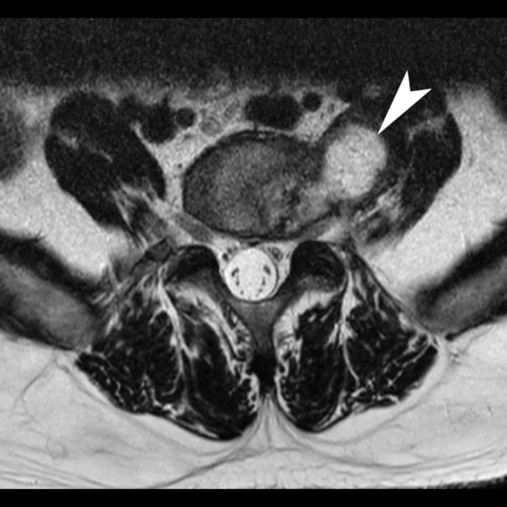 Spinal infection. This 50-year-old man who was previously healthy reported acute-onset low back pain which progressively worsened over the prior week, causing him to be unable sleep or stand upright. Lumbar magnetic resonance imaging showed a 3.2×3.1×3.0-centimeter T2-weighted hyperintense lobulated lesion at the left L5/S1 paraspinal region involving the left psoas muscle (arrowhead in axial T2-weighted axial image), with apparent connection with the left side of the intervertebral disc. The chiropractor consulted with an on-site orthopedic surgeon and referred the patient to the emergency department, where he was treated for a psoas abscess and spondylodiscitis. Arrow added by RT using GNU Image Manipulation Program (Version 2.10.30).