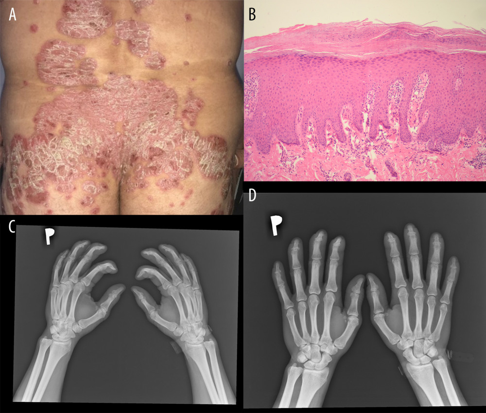Clinical, pathological, and radiological manifestations of psoriasis. (A) Clinical presentation. (B) Pathological picture of psoriasis. Hematoxylin and eosin, 100× (C, D) Radiological pictures of psoriasis arthritis.