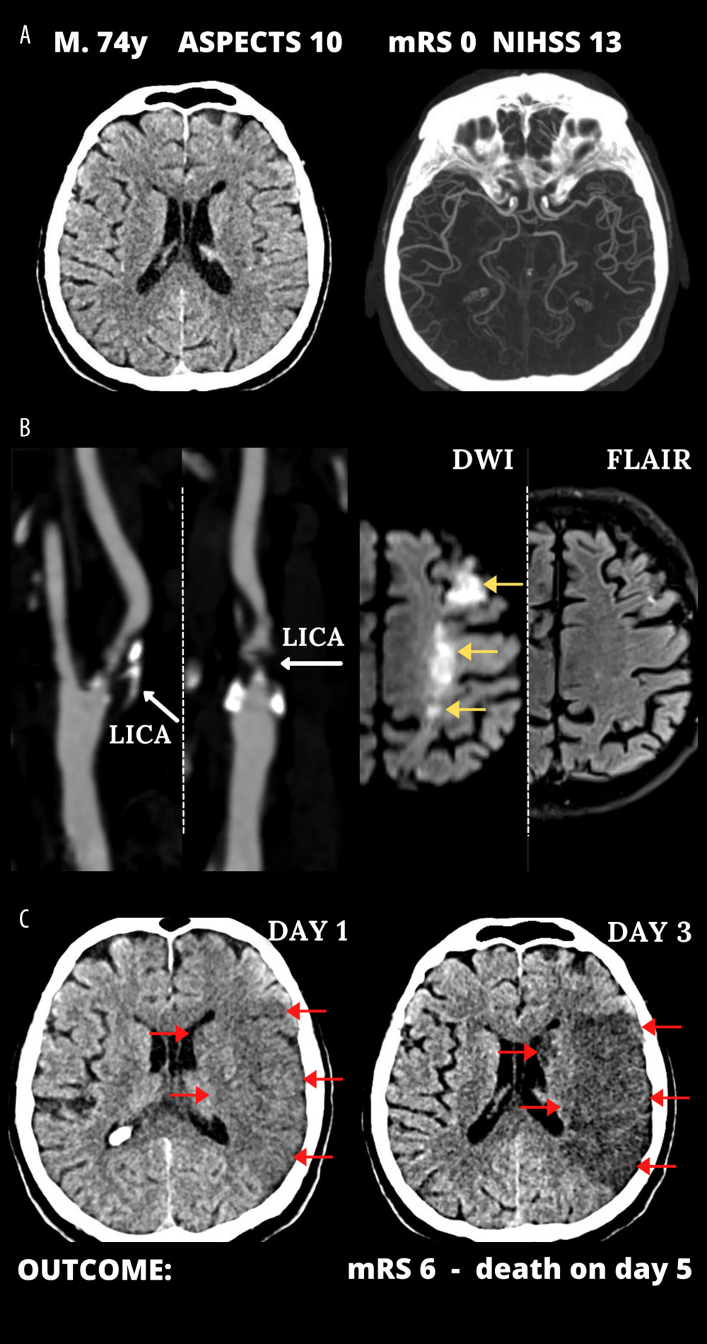 Typical cerebral infarct evolution in an acute ischemic stroke of the carotid artery origin in emergency mechanical reperfusion (EMR) eligible patient that did not receive EMR (EMR-untreated). (A) Admission cerebral computed tomography (day 0) was normal; Alberta Stroke Program Early Computed Tomography Score (ASPECTS) 10 in a man presenting with left hemispheric stroke symptoms of increasing severity National Institutes of Health Stroke Scale (NIHSS) – 13 (left) and computed tomography angiography showed no intracranial artery occlusion and good collaterals (Tan 3) (right). (B) Sub-occlusive left internal carotid artery (LICA) stenosis (left); magnetic resonance imaging demonstrated potentially reversible hyperacute left-sided diffusion restriction on diffusion-weighted imaging (DWI, yellow arrows) which are absent on the fluid-attenuated inversion recovery (FLAIR) sequence (right). IV thrombolysis was started, and the patient was observed for thrombolysis effect; there was no referral for EMR. Neurologic status gradually deteriorated. (C) Large cerebral tissue loss (red arrows) seen on control computed tomography 12 hours after 1st scan (left, thrombolysis ineffective, collateral supply exhaustion) and on day 3 (right). Figure was created with the use of Canva (Perth, Australia).